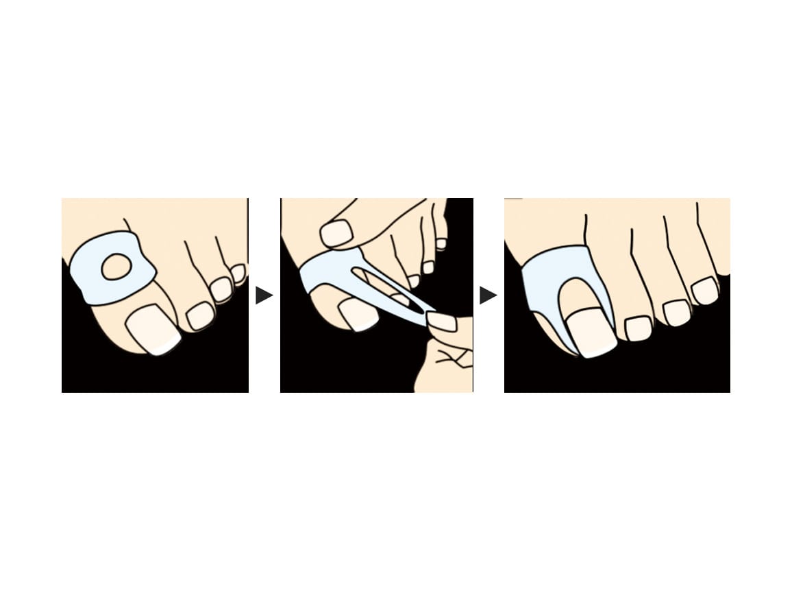 巻き爪ゲルエイド(2個入り) 巻き爪ゲルエイド(2個入り)