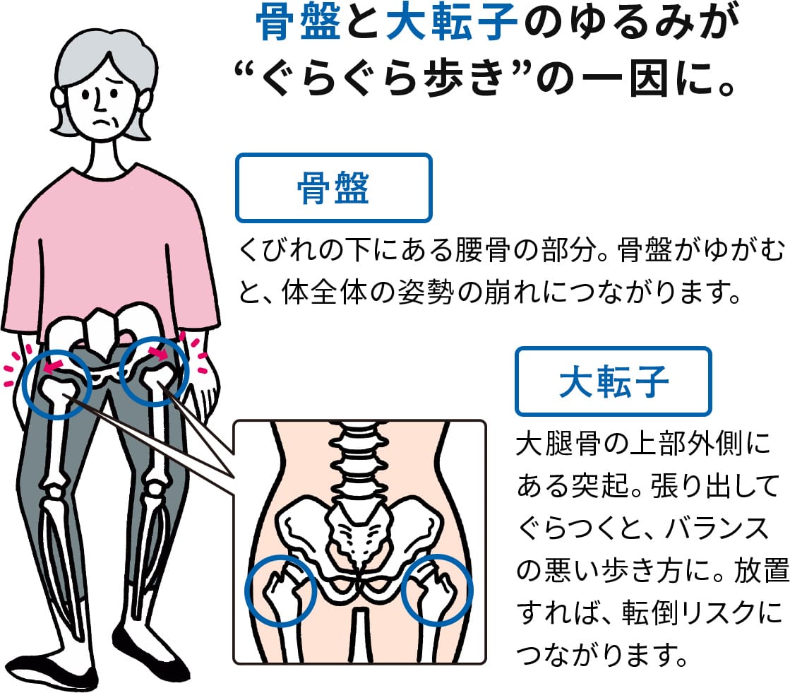 骨盤と大転子のゆるみが “ぐらぐら歩き”の一因に。